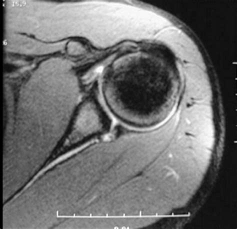 anterior posterior labral tear test|shoulder labral tear orthobullets.